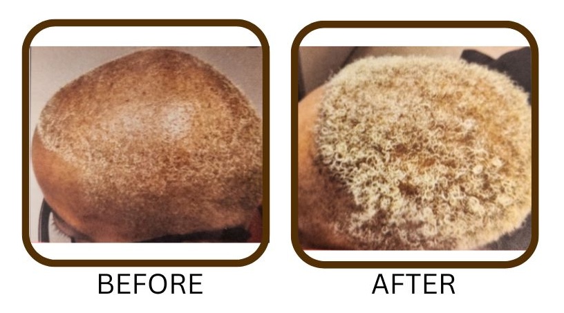 Before and After treatment images of top of black female head showing new hair growth
